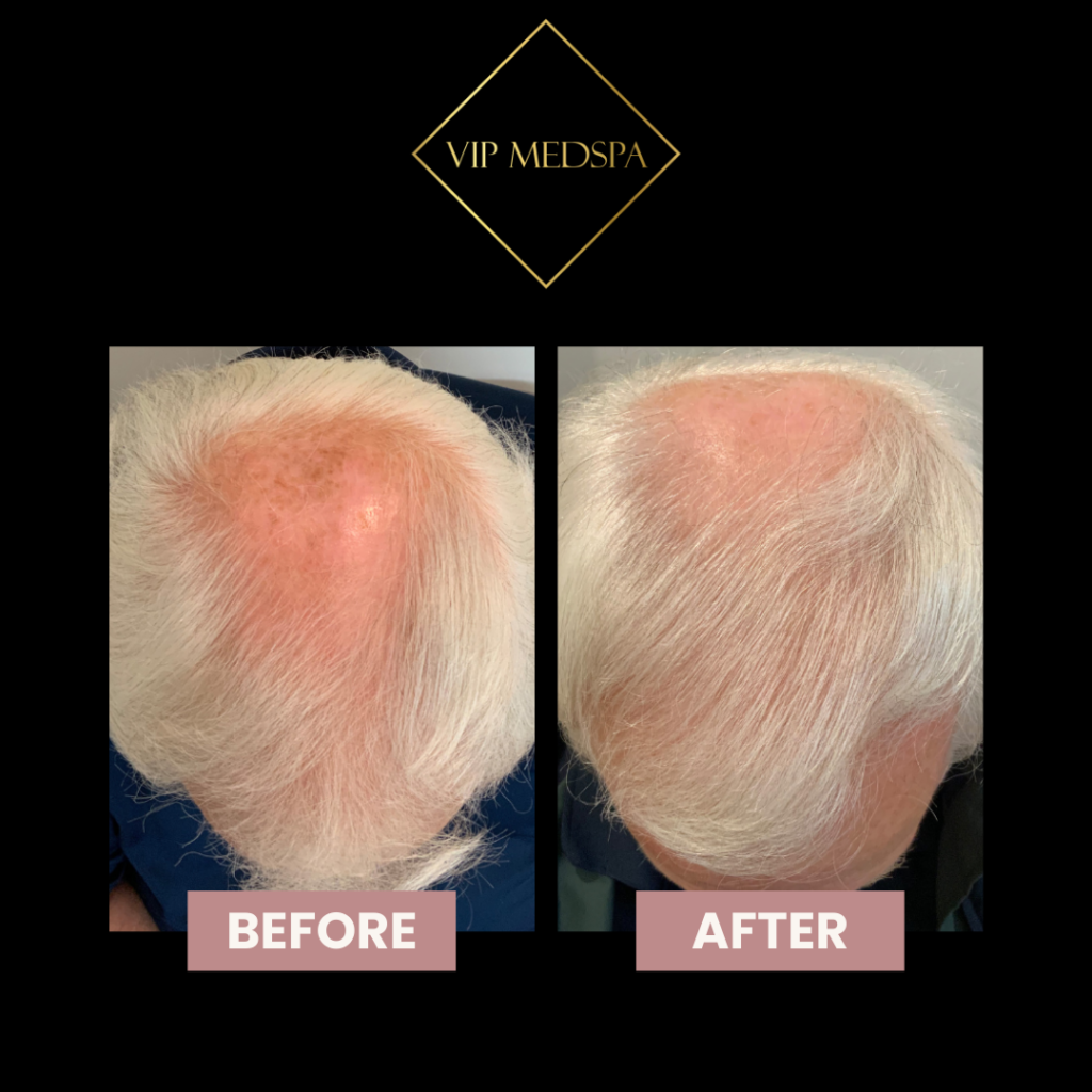 TED Hair Restorationa