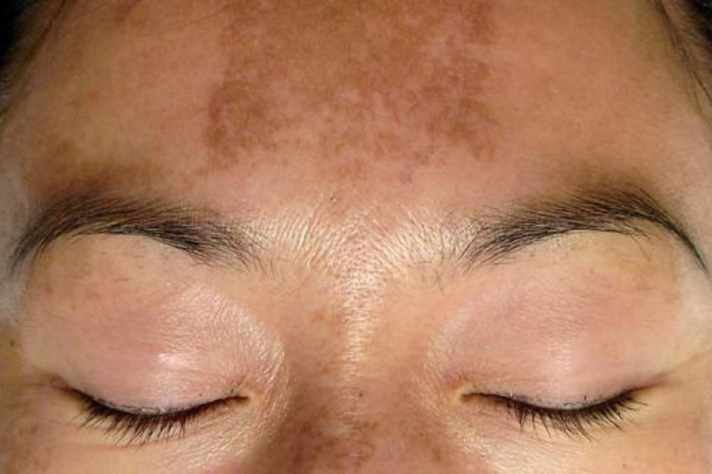 Melasma Condition