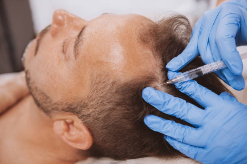 PRP for Hair