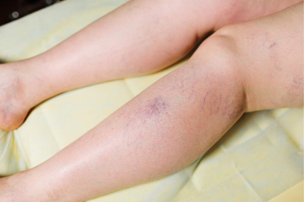 Leg Vein Reduction Spider Vein & Varicose in Toronto