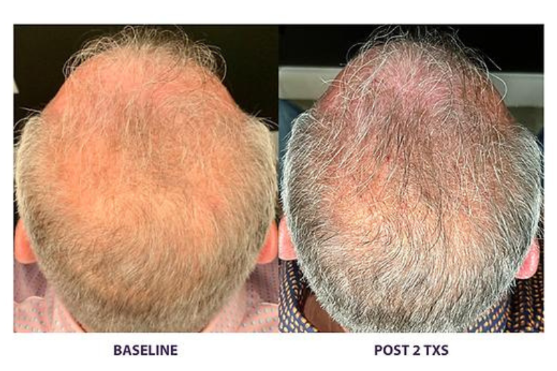 TransEpidermal Delivery (TED) Hair Restoration