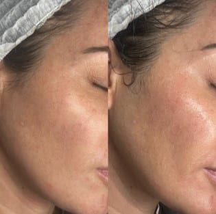 HydraFacial - VIP MEDSPA